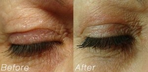 Blepharoplasty1