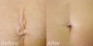 Dilated-Periumbilical-Striae1