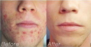 acne-treatment1